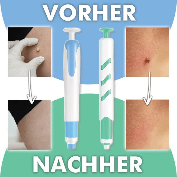 Bel Hills Wart-Free PRO - The Professional Wart Remover